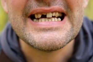 what is meth mouth